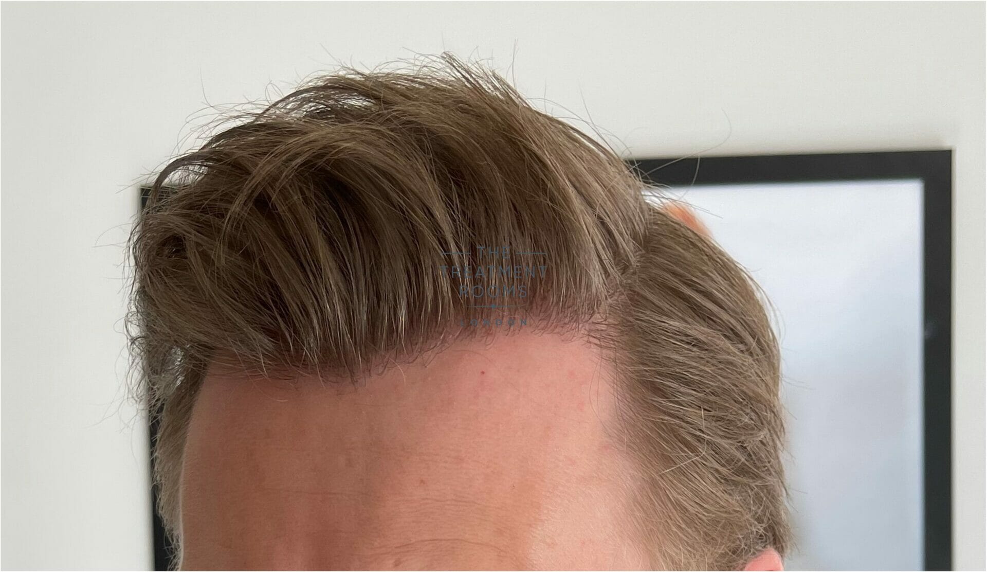 Top Months After Hair Transplant Polarrunningexpeditions