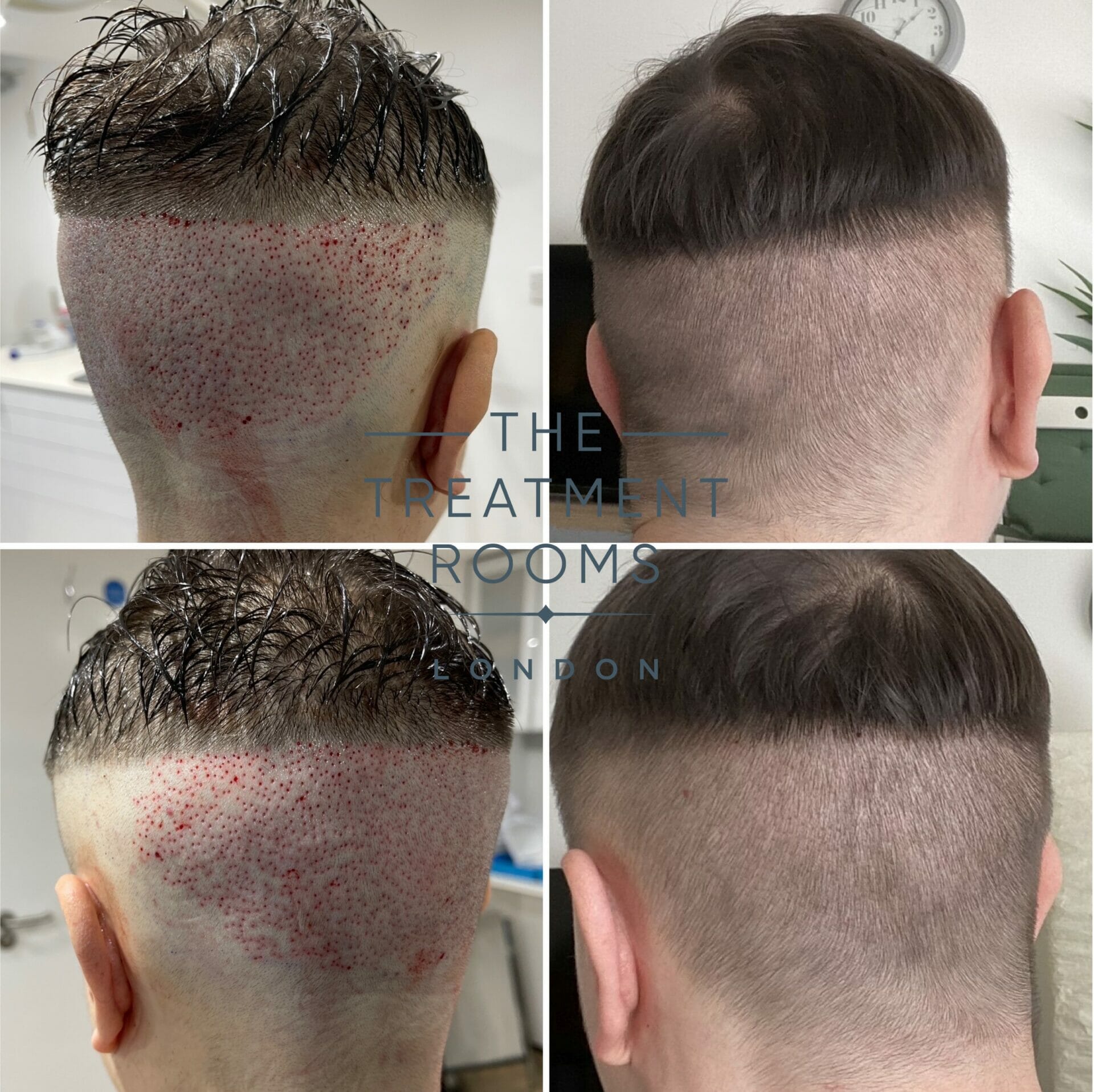 Unshaven FUE Hair Transplant UFUE The Treatment Rooms London