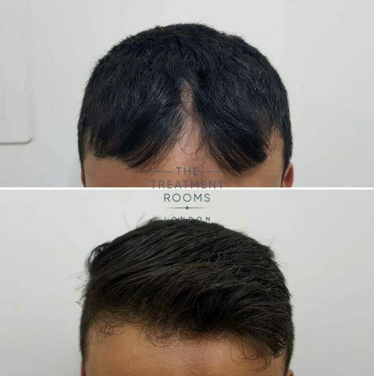 How Many Hair Grafts Do I Need For My FUE Hair Transplant?