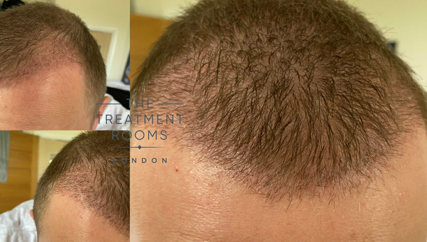 Hair transplant after one month  Treatment Rooms London
