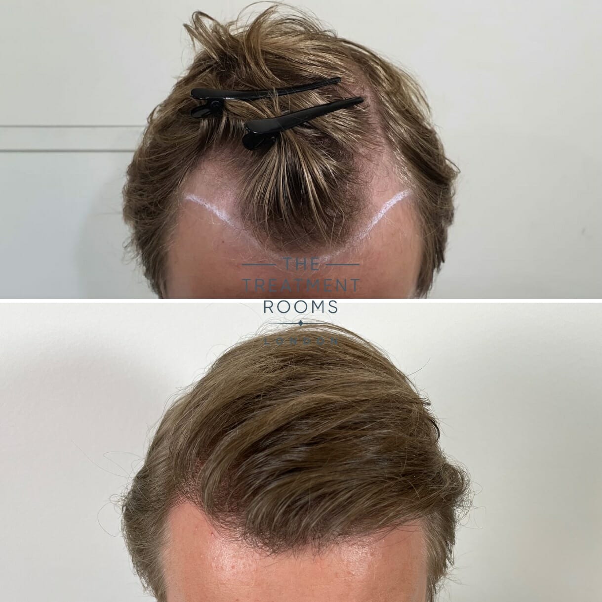 Solve Clinics  Hair Transplant Results FUE method 2000 grafts   PRP   11 months postop final results can be expected in 1215 months  Minimally invasive natural  permanent results Schedule