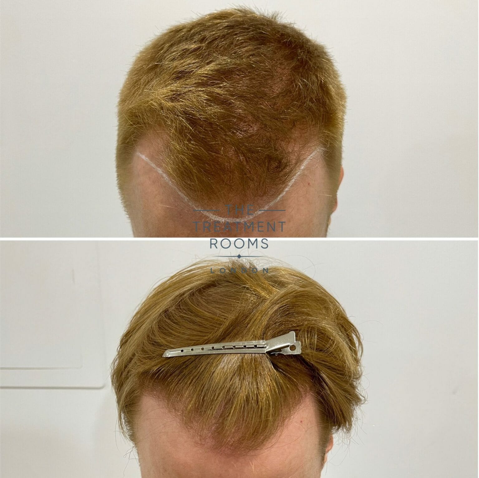 Fue Transplant Before And After Treatment Rooms London