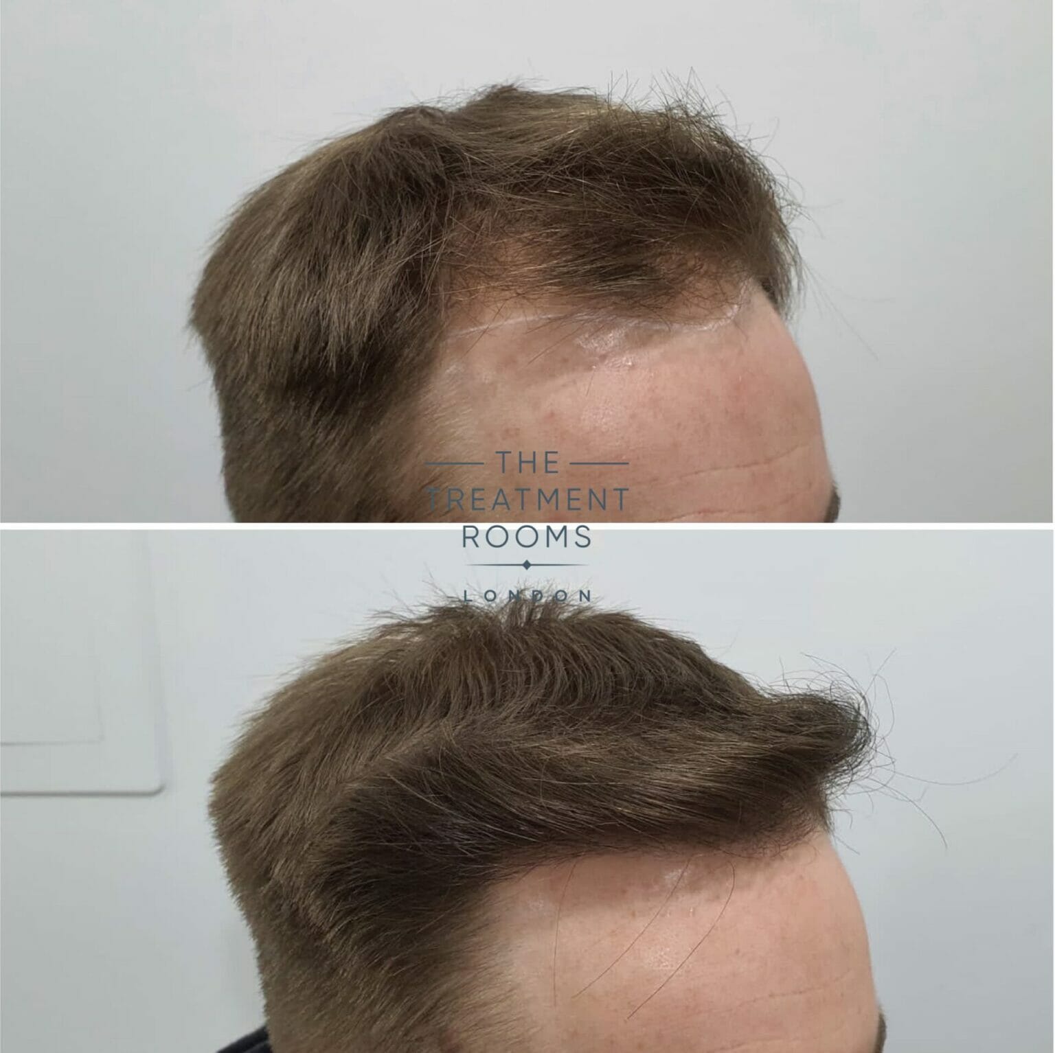 FUE Transplant Before & After | Treatment Rooms London