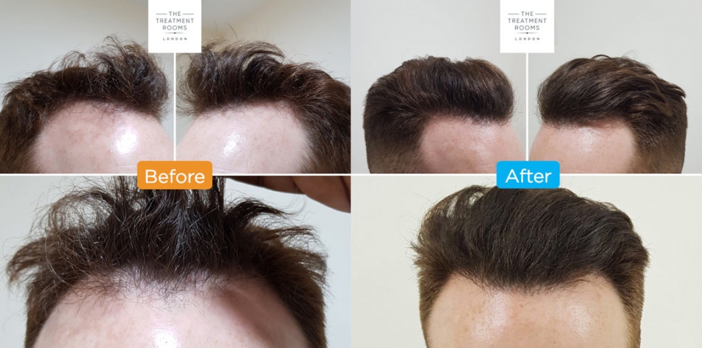 Hair Transplant Surgery- The Treatment Rooms London