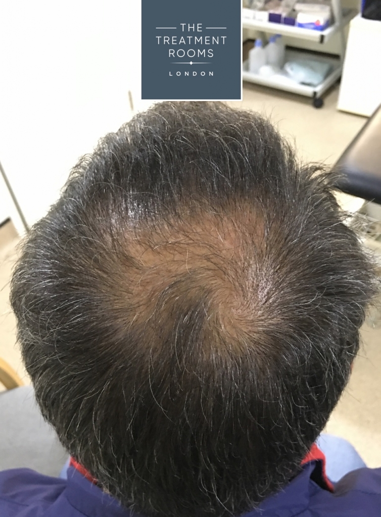 Crown Hair Transplant - The Treatment Rooms London