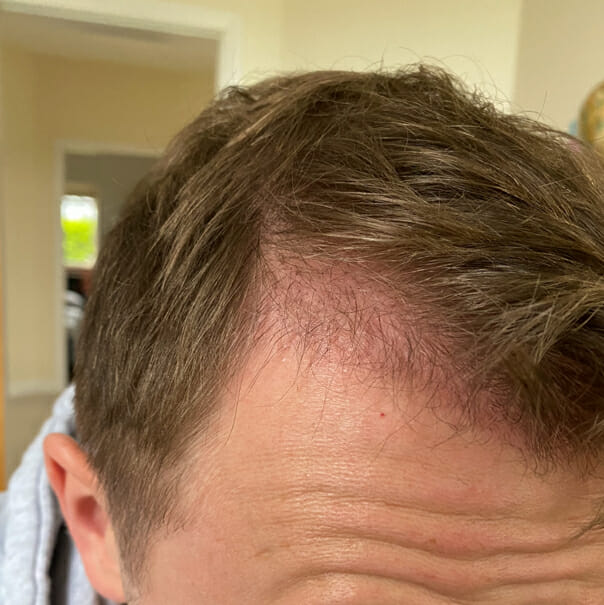 Post Op Recovery Photographs – 2 Weeks After FUE Hair Transplant Procedure