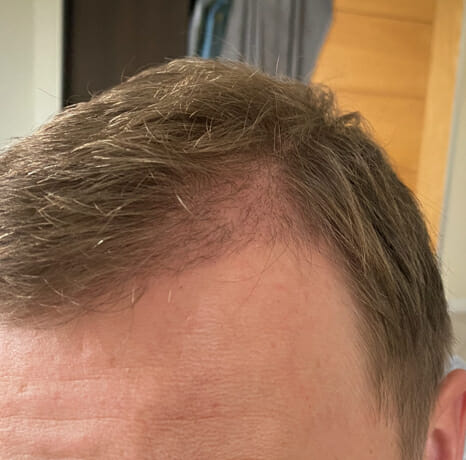 hair transplant results after 2 months