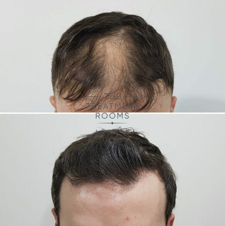 How Many Hair Grafts Do I Need For My FUE Hair Transplant?