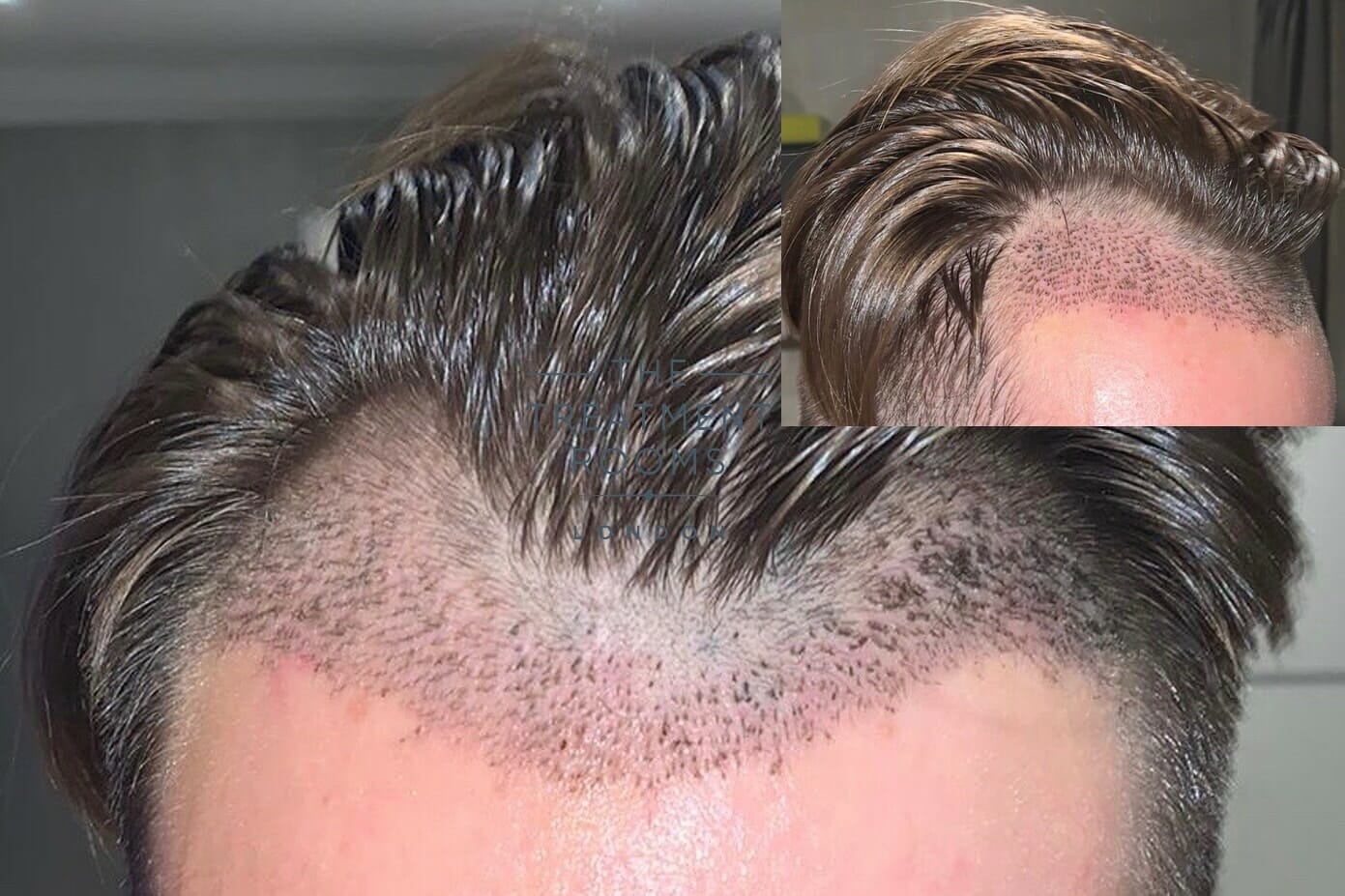 fue hair transplant after 20 days
