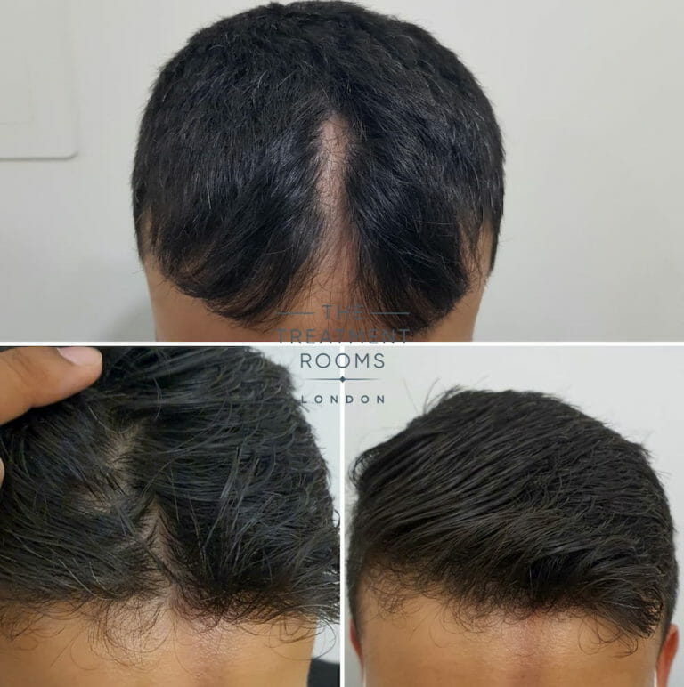 Hair Transplant Scar Repair Through FUE | Treatment Rooms London