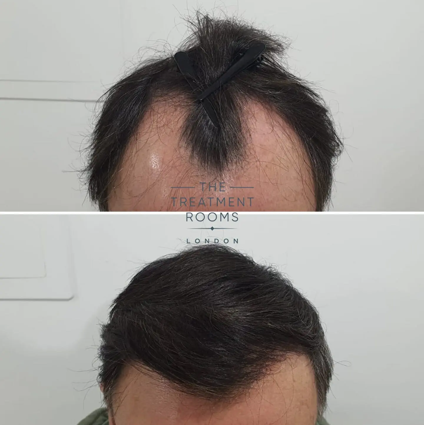 FUE Transplant Before & After