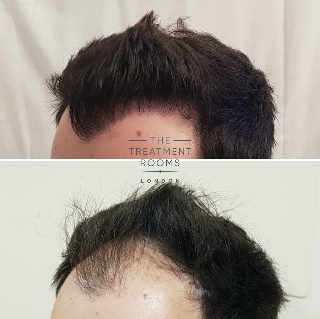 Fue Hair Transplant Before And After Treatment Rooms London 2913