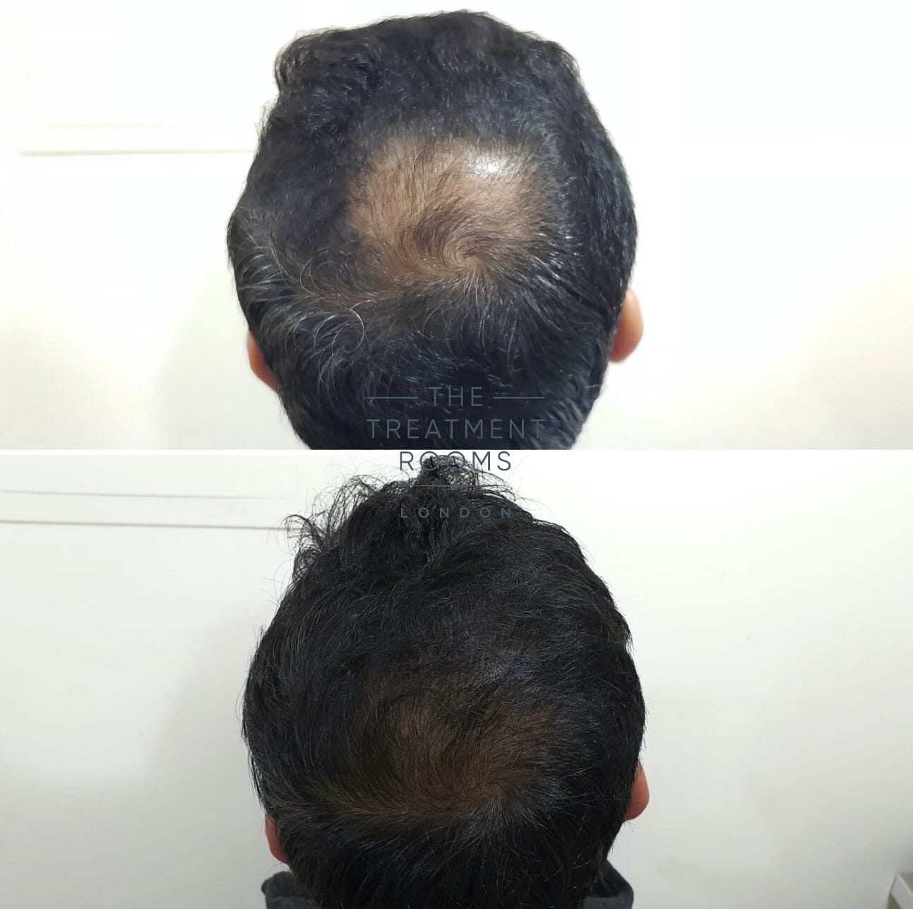 FUE Hair Transplant Before And After | Treatment Rooms London