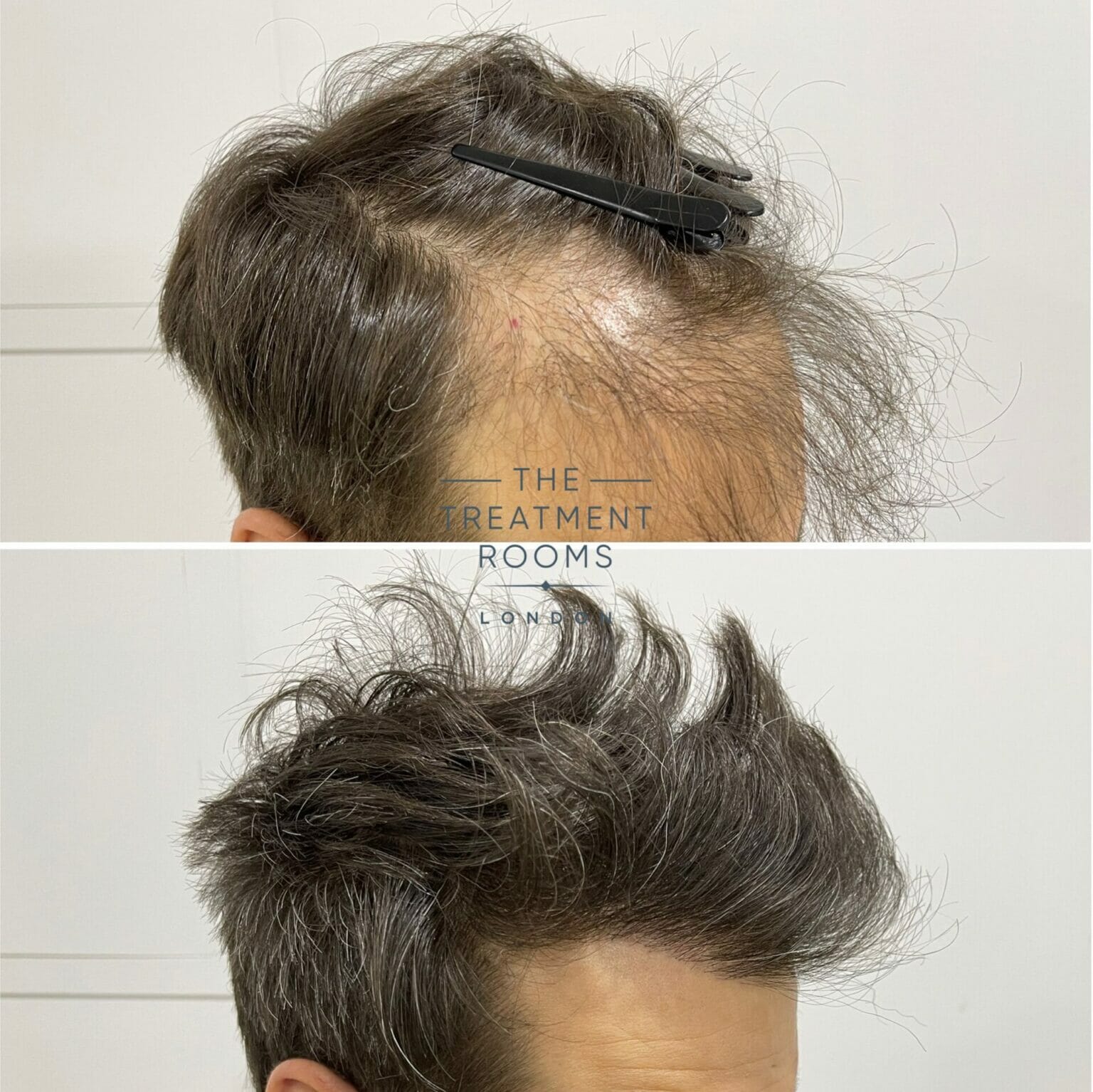 Direct Hair Implantation | The Treatment Rooms London