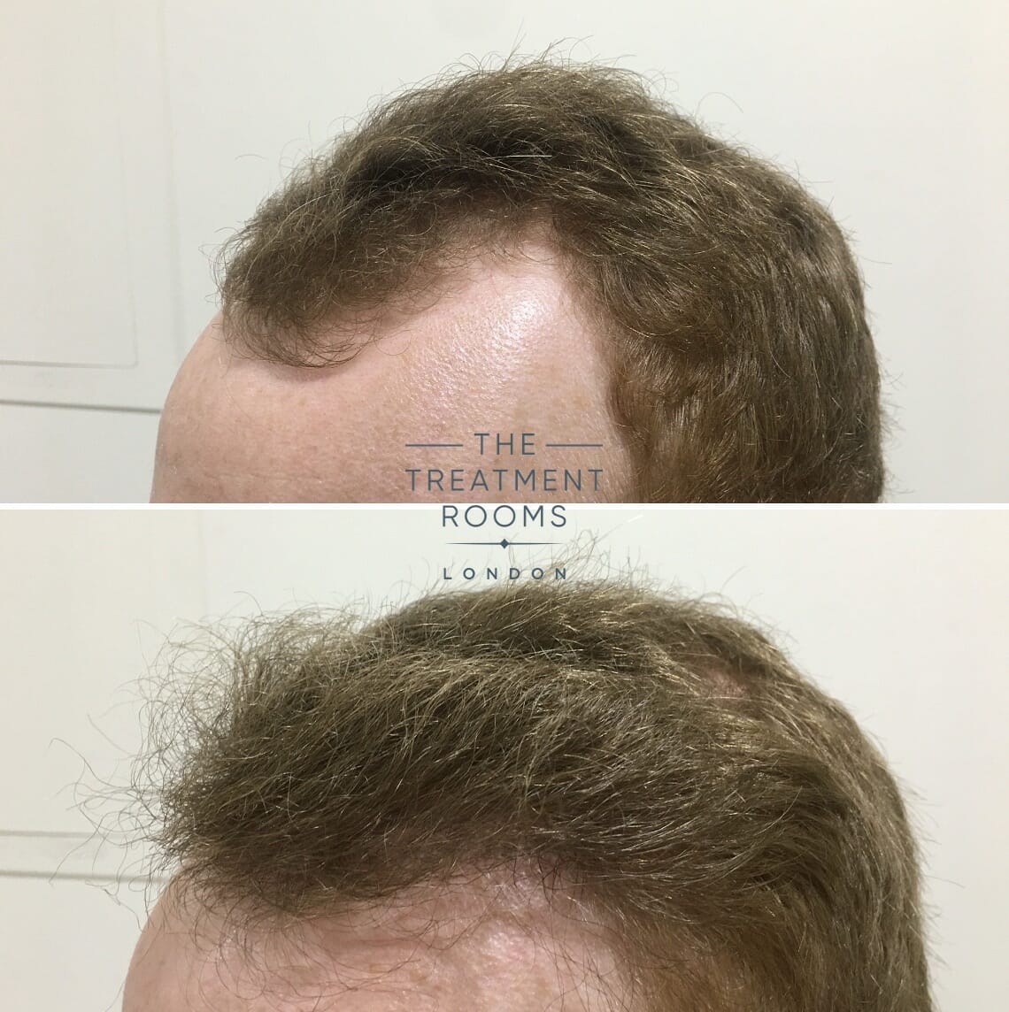 Do You Need To Take Minoxidil After