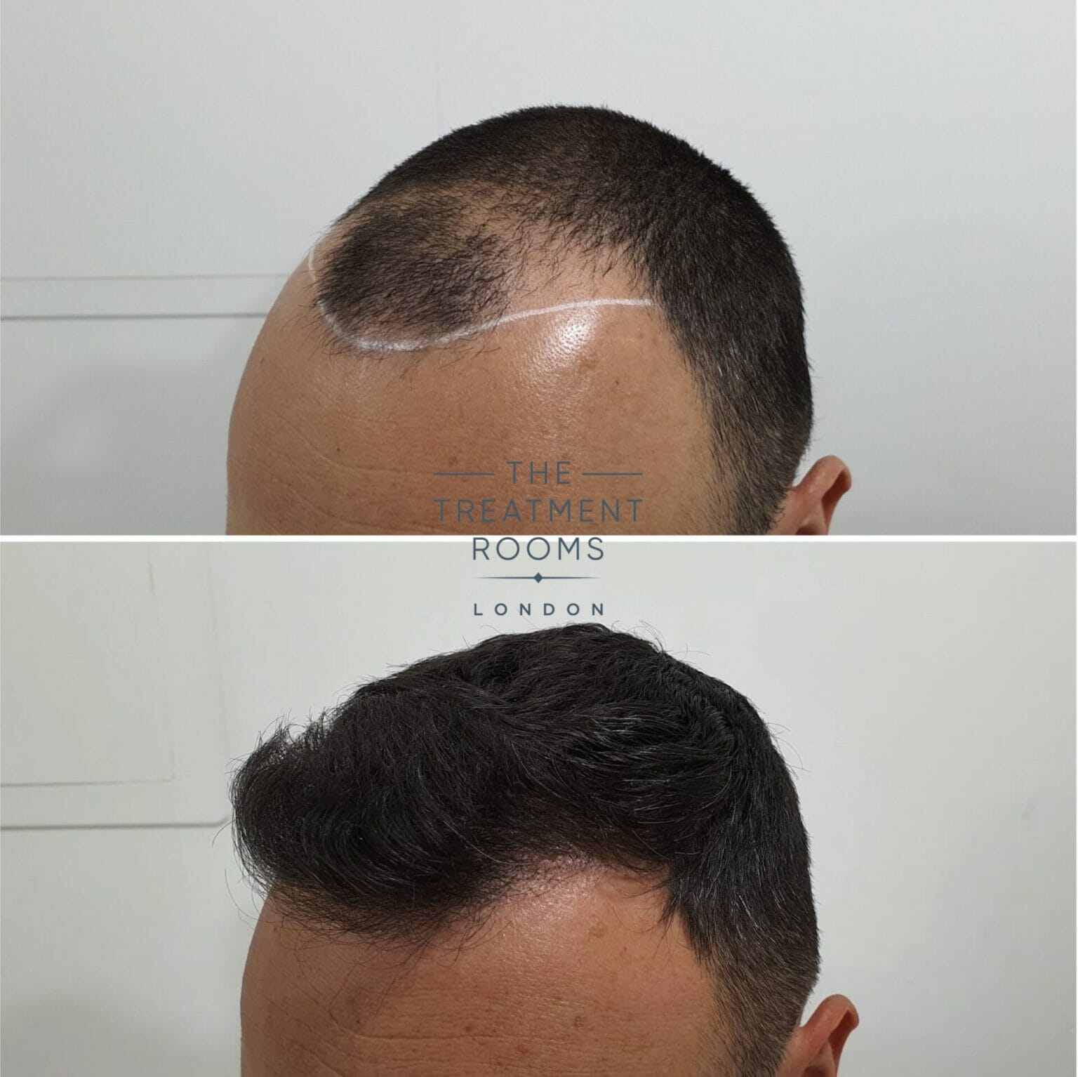 What You Need To Know About Shedding After A Hair Transplant ...