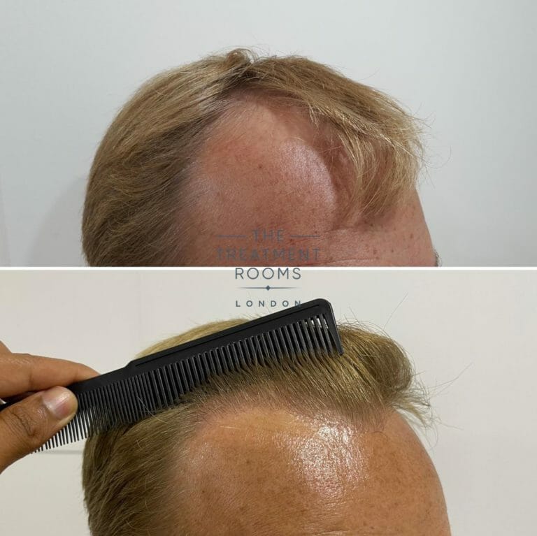 FUE Transplant Before & After | Treatment Rooms London