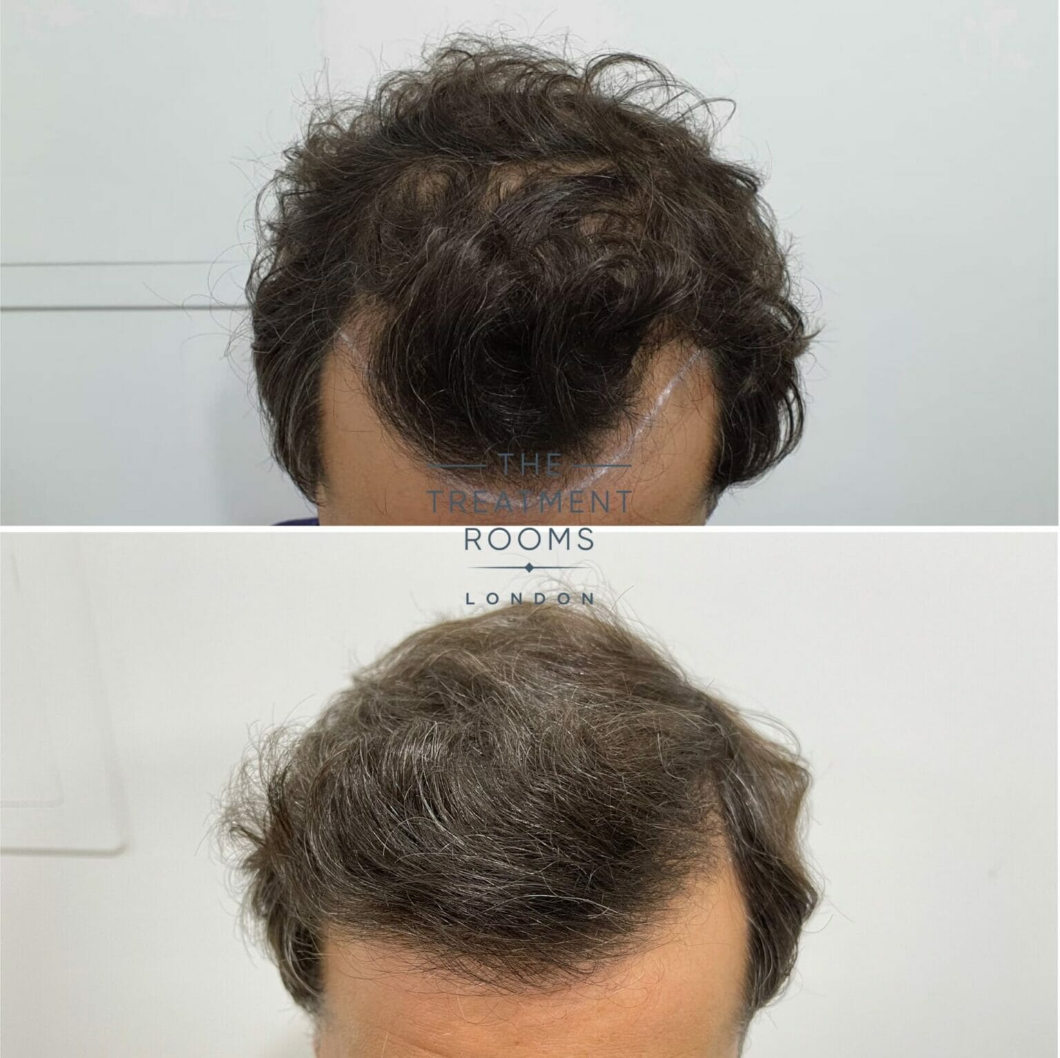 Fue Hair Transplant Before And After 