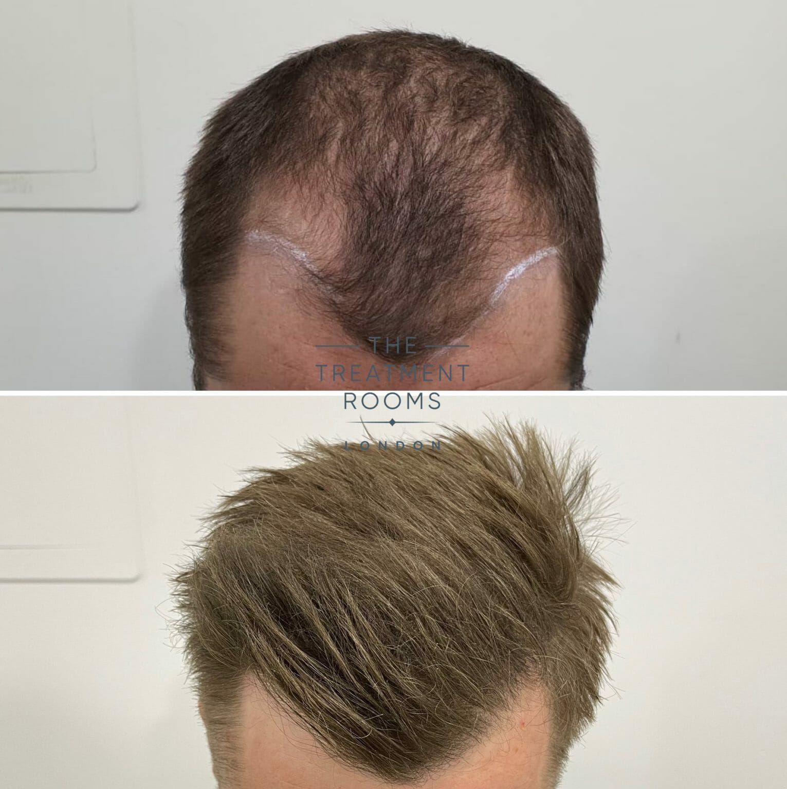 Temple Hair Loss And Temple Hair Transplant Treatment Rooms London 7714