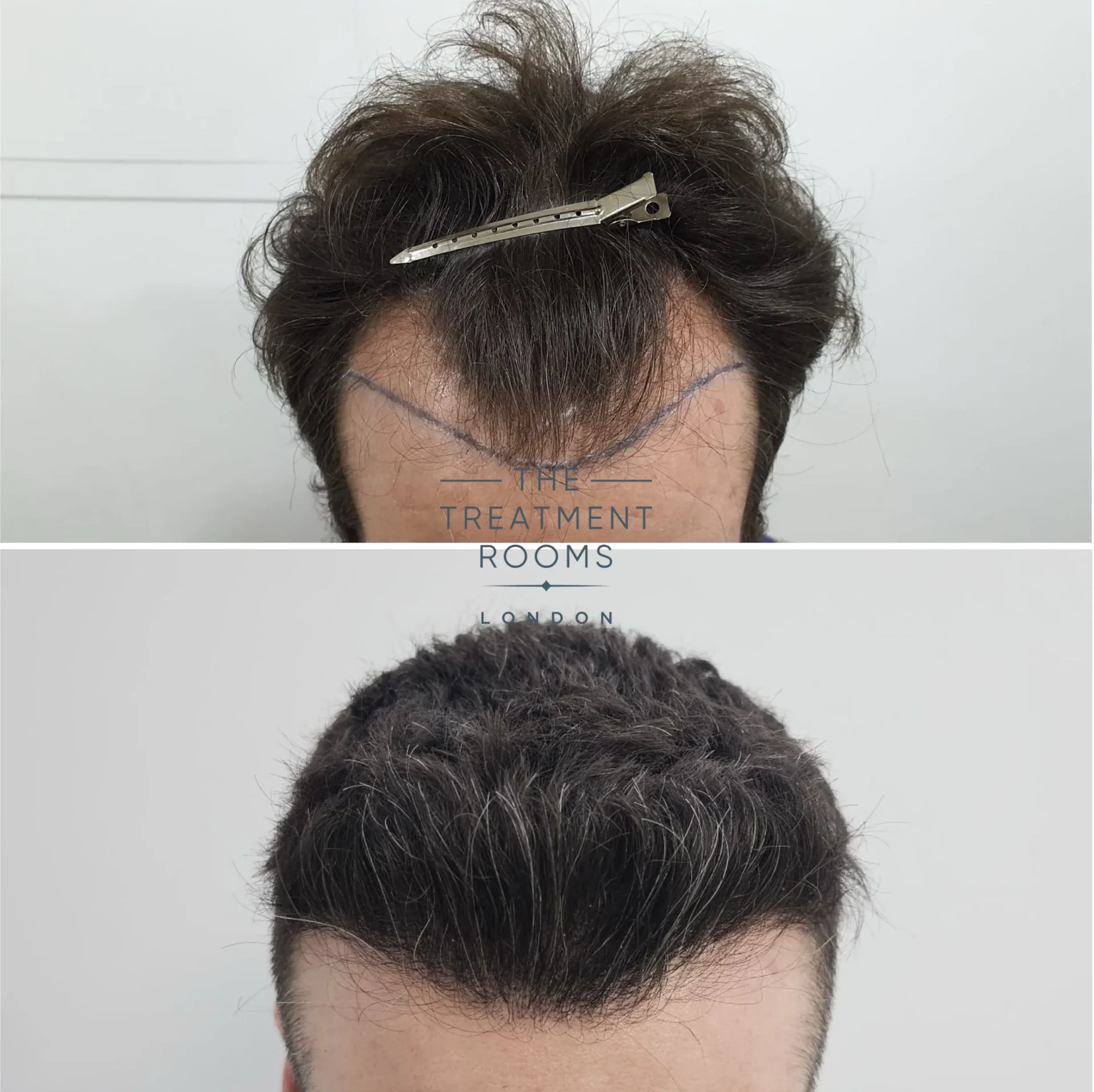 best fue hair transplant clinic in london review