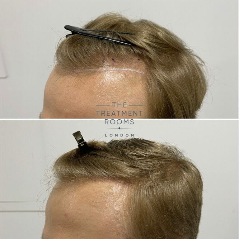 Fue Hair Transplant 616 Grafts Treatment Rooms London