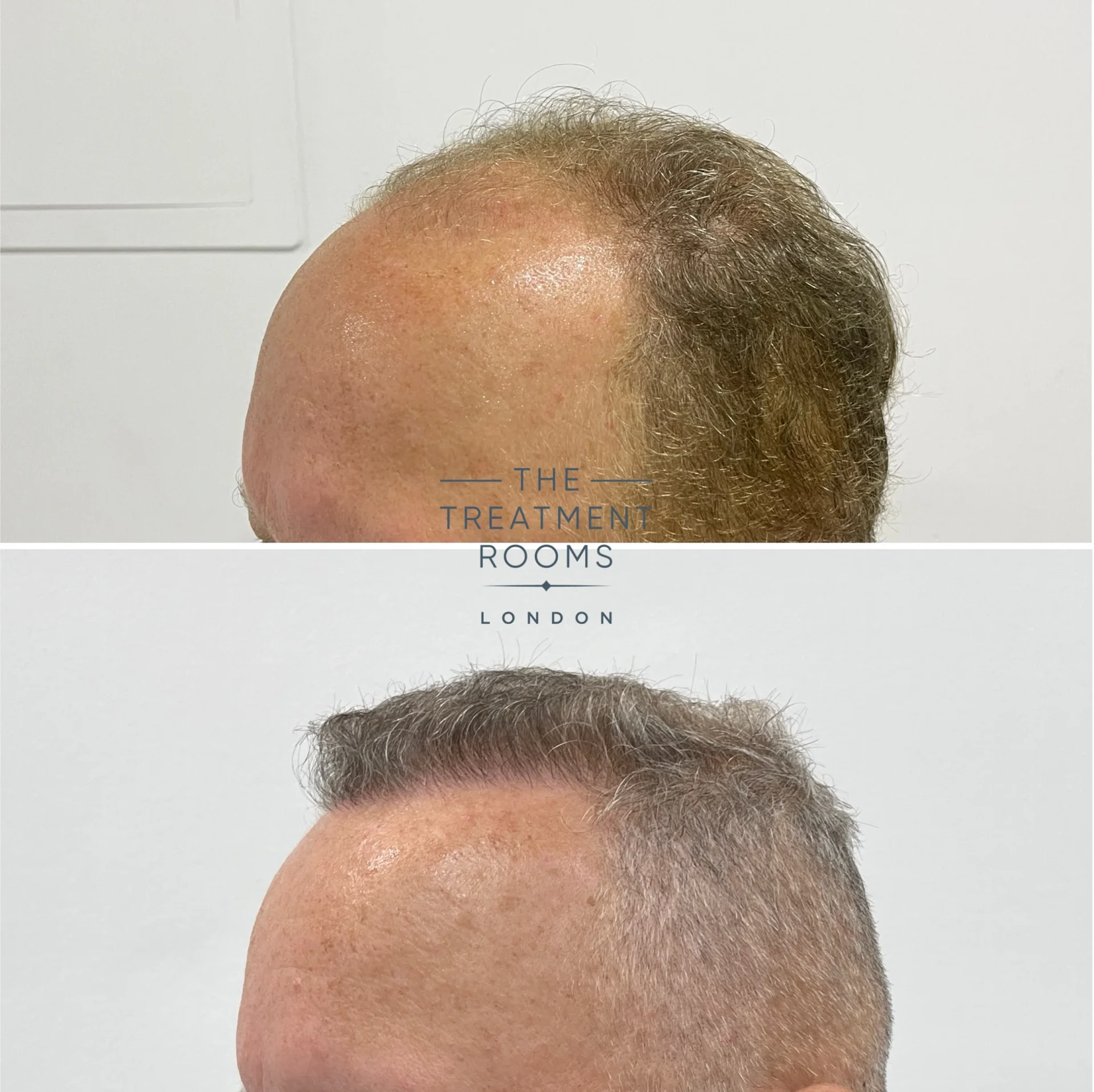 grey hair transplant before and after 1810 grafts
