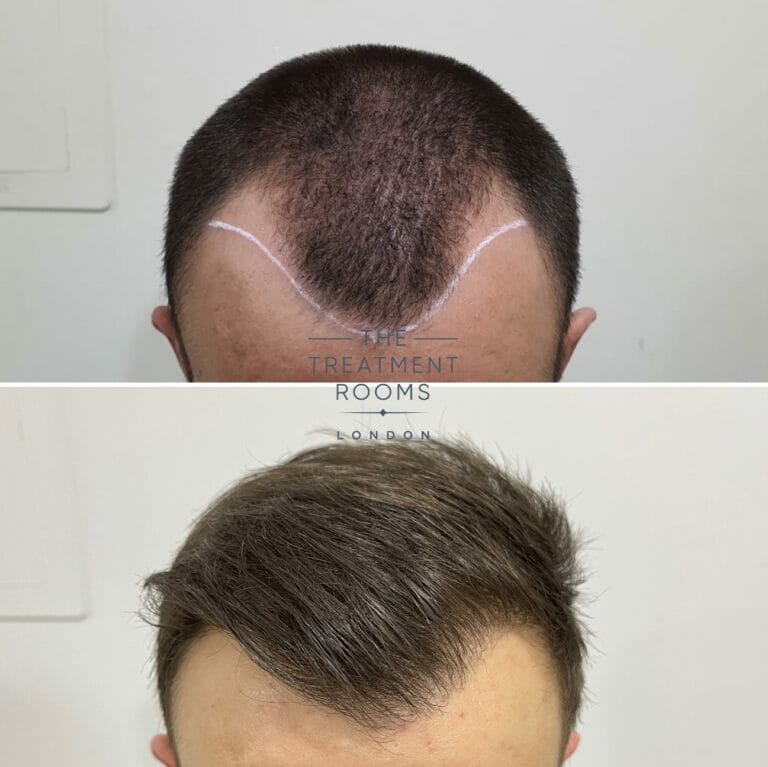 What Our Patients Think | Hair Transplant Reviews