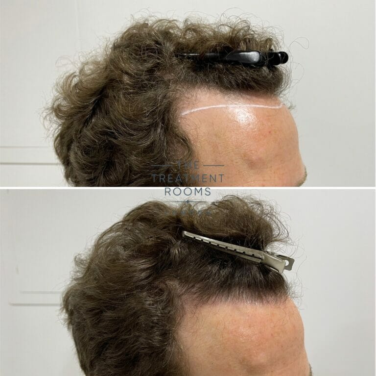 Hair Transplant Before And After 1304 Grafts Treatment Rooms London