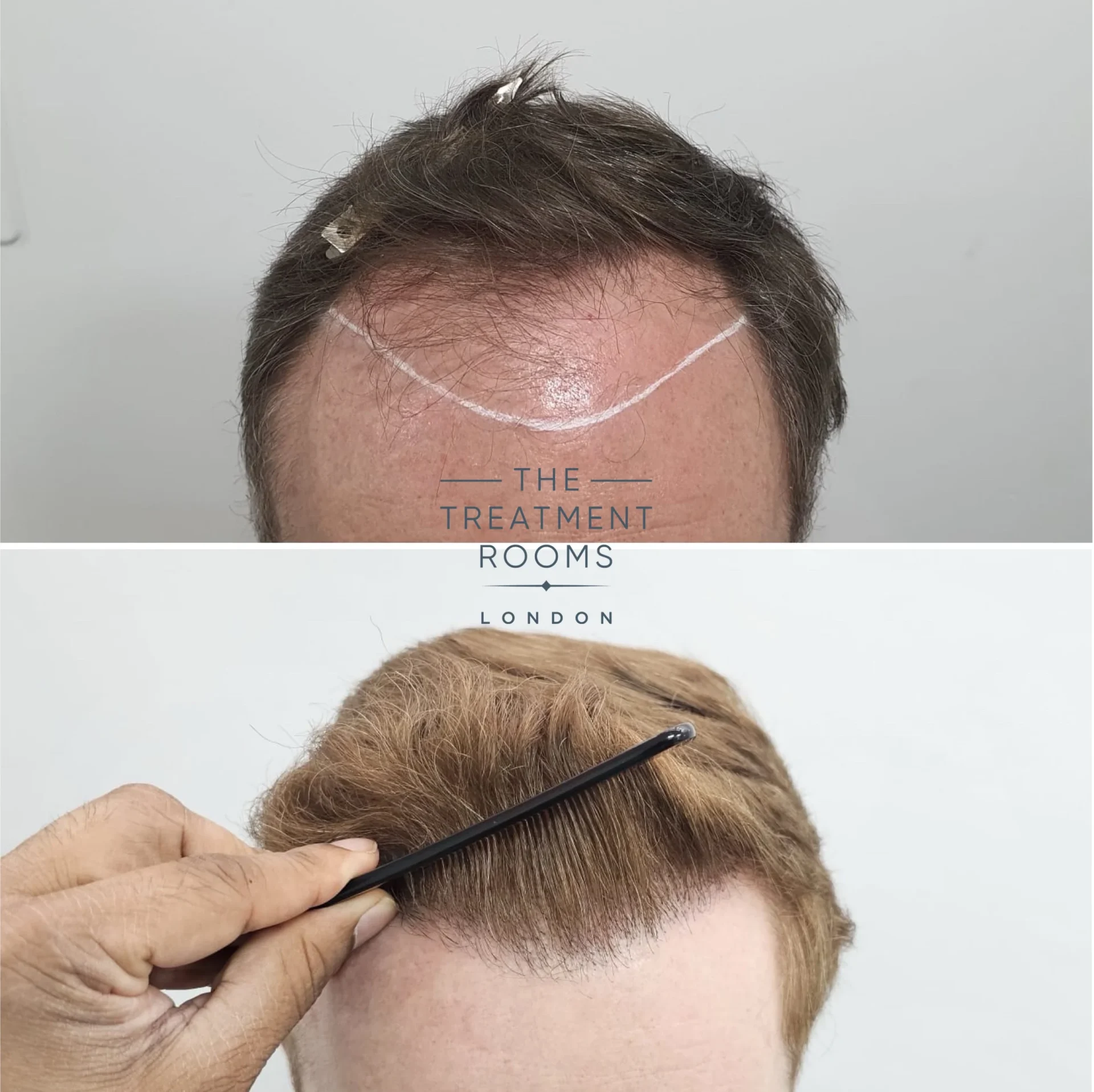 hairline hair transplant london 2189 grafts before and after