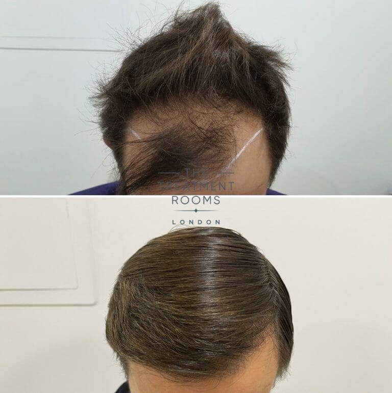 FUE Transplant Before & After | Treatment Rooms London