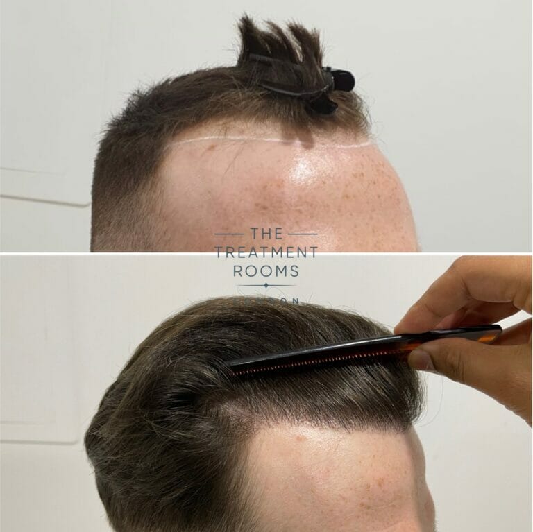 A Guide To High Density Hair Transplantation - Hair Transplant 