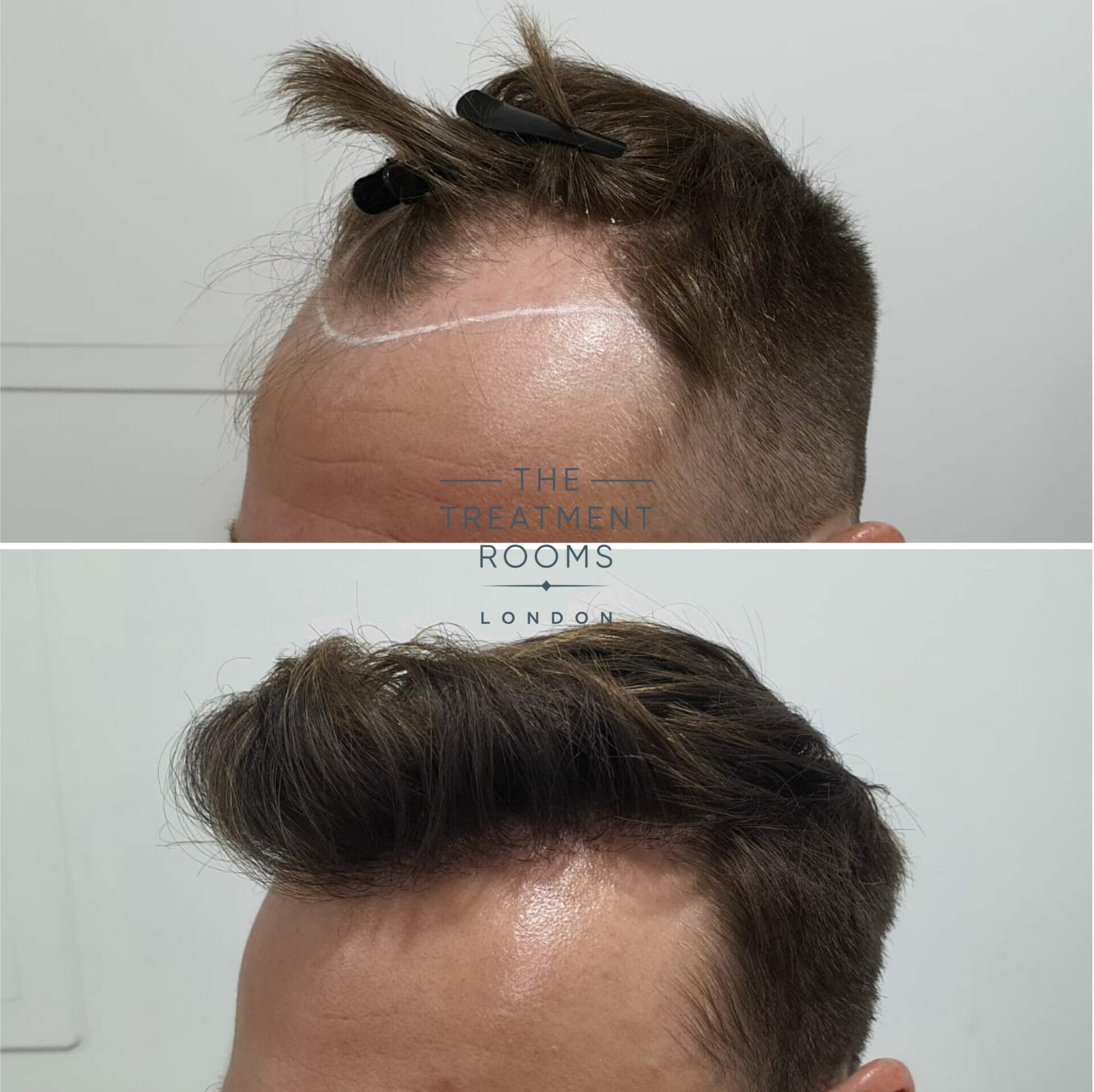 Best Hair Fall Treatment for Men Effective Hair Loss Treatment