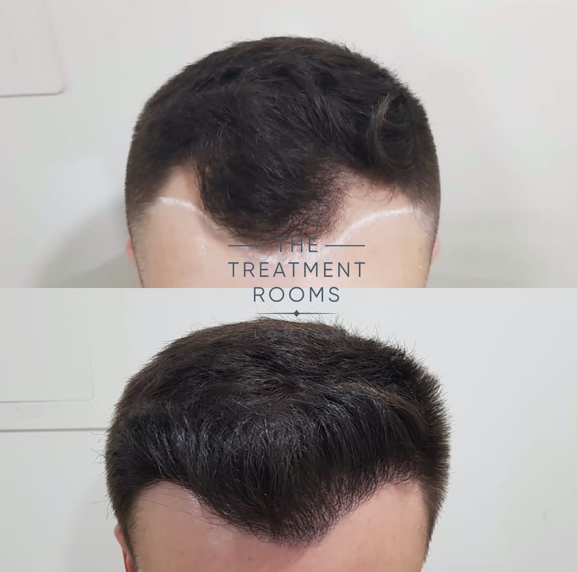 London Hair Transplant Aftercare & Recovery | Treatment Rooms London