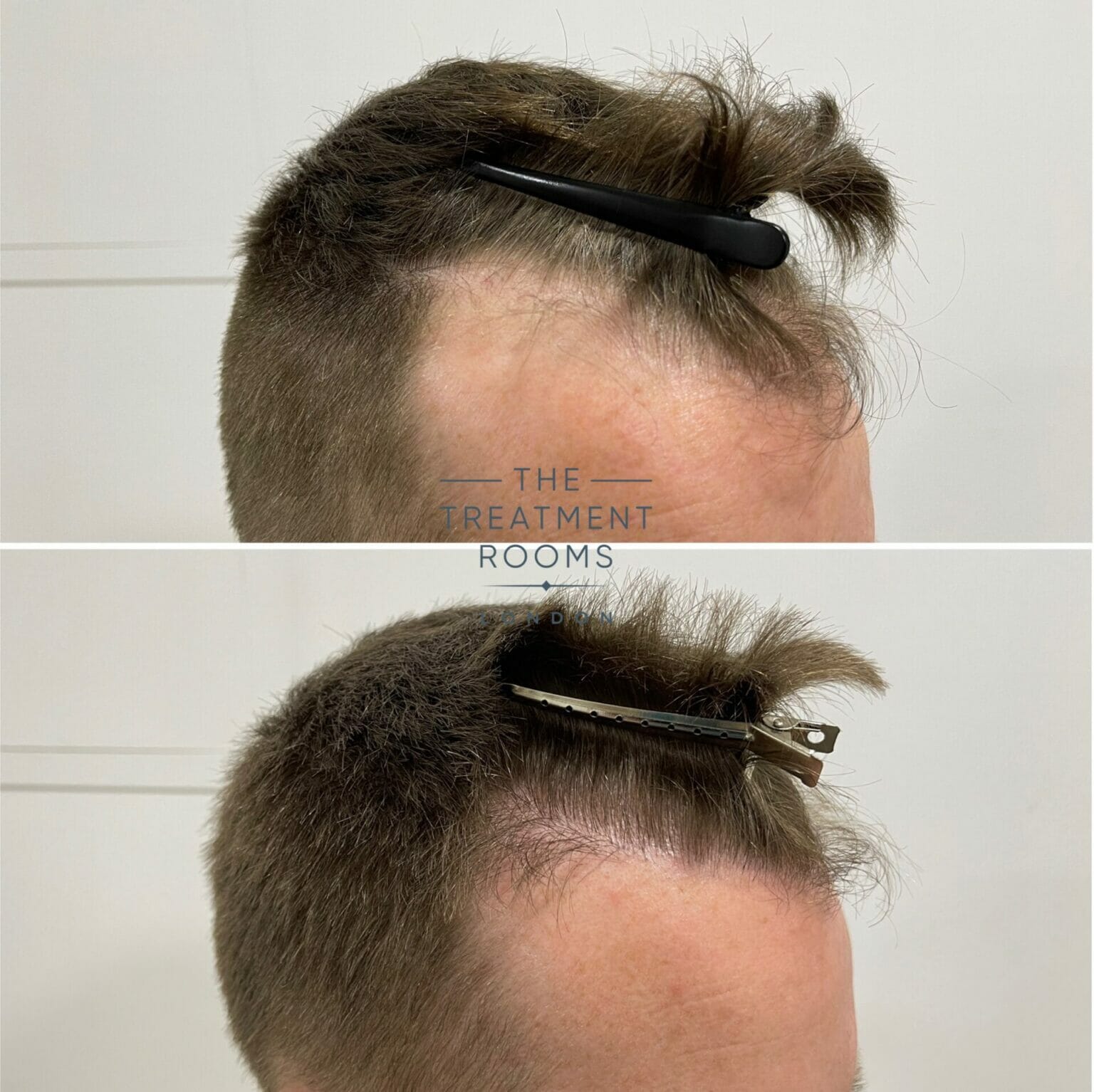 Fue Hair Transplant 1073 Grafts Treatment Rooms London