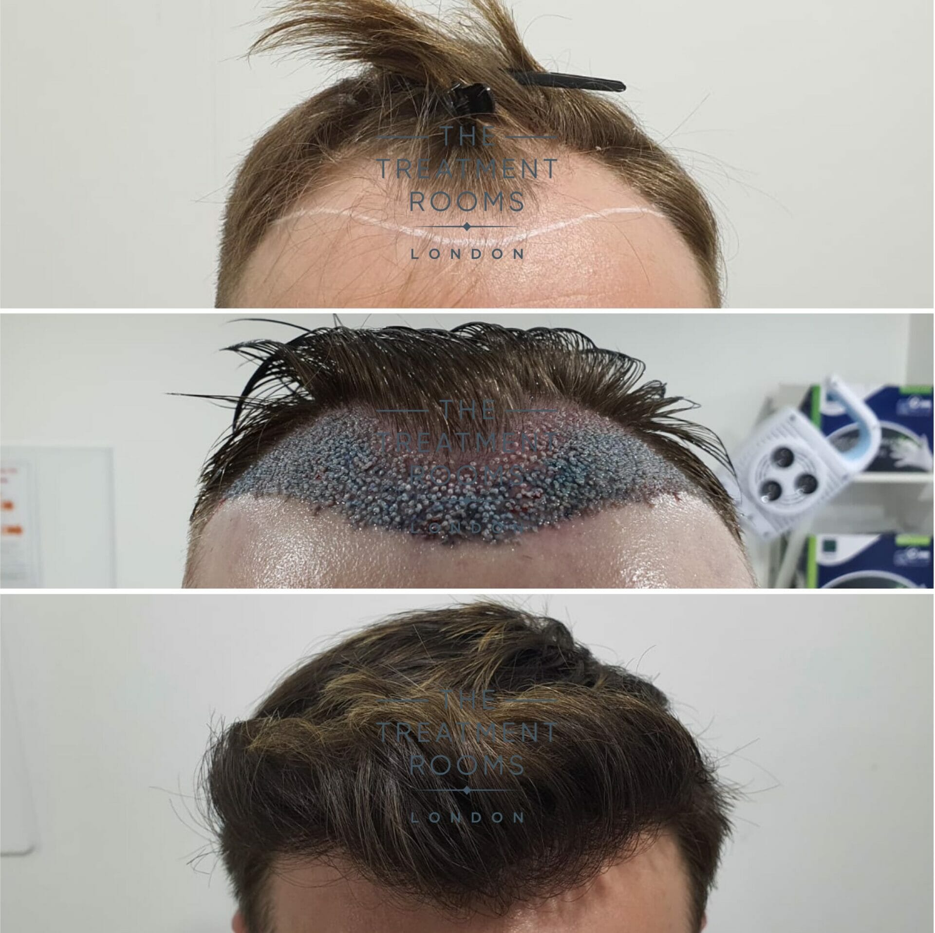 Unshaven FUE Hair Transplant UFUE  The Treatment Rooms London